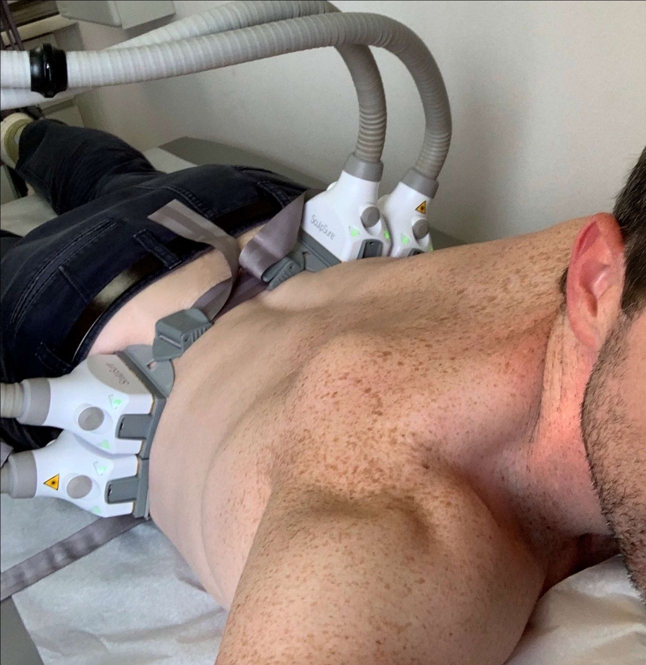 WarmSculpting procedure
