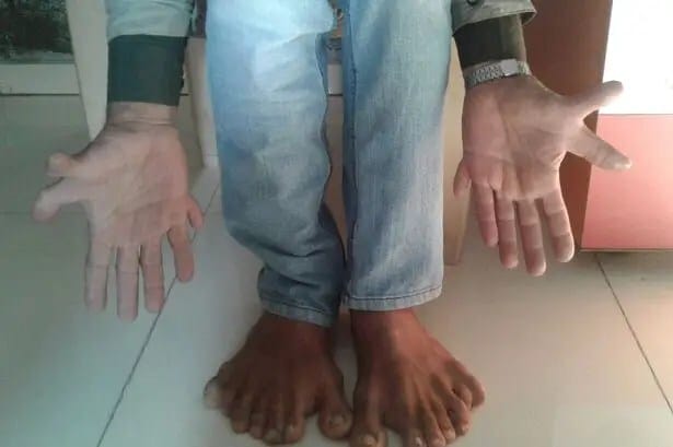 PAY-Devendra-Suthar-showing-his-28-fingers-and-toes