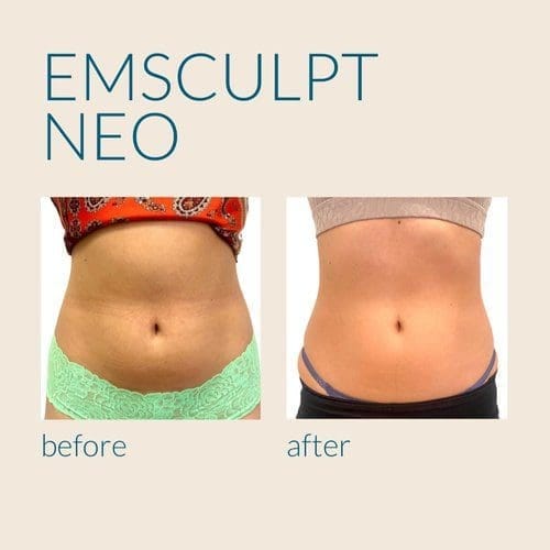 A before and after picture of an emsculpt neo treatment.