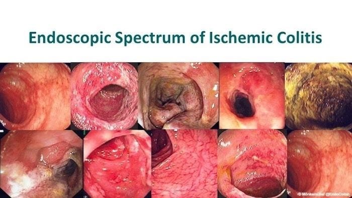 Endoscopic Spectrum Of Ischemic Colitis From Mild To Severe