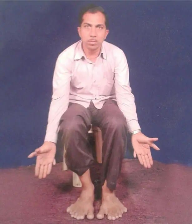 PAY-Devendra-Suthar-showing-his-28-fingers-and-toes (1)