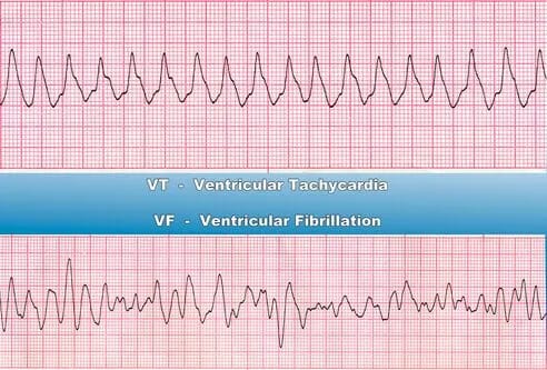 Two ECGs, ventricular tachycardia on top, ventricular fibrillation on bottomm