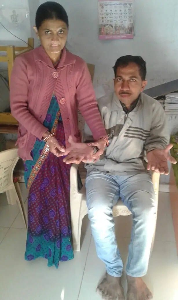 PAY-Devendra-Suthar-showing-his-28-fingers-and-toes (2)