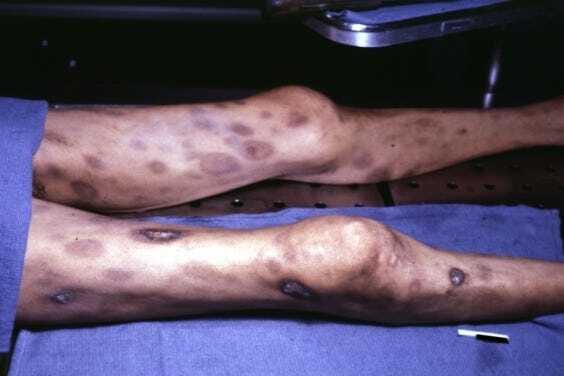 AN advanced case of disseminated intravascular coagulopathy.