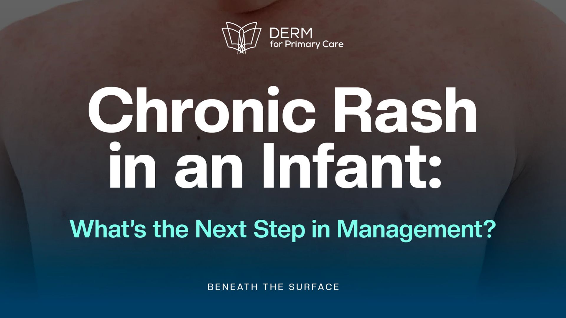 Case Study: 5-Month-Old with a Chronic Rash. What’s Your Next Step?