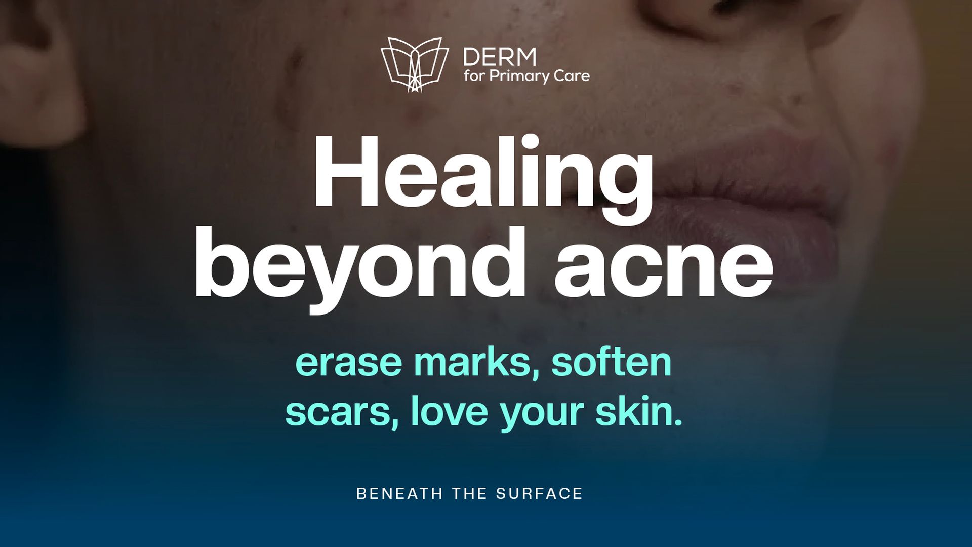 Acne Marks and Scars