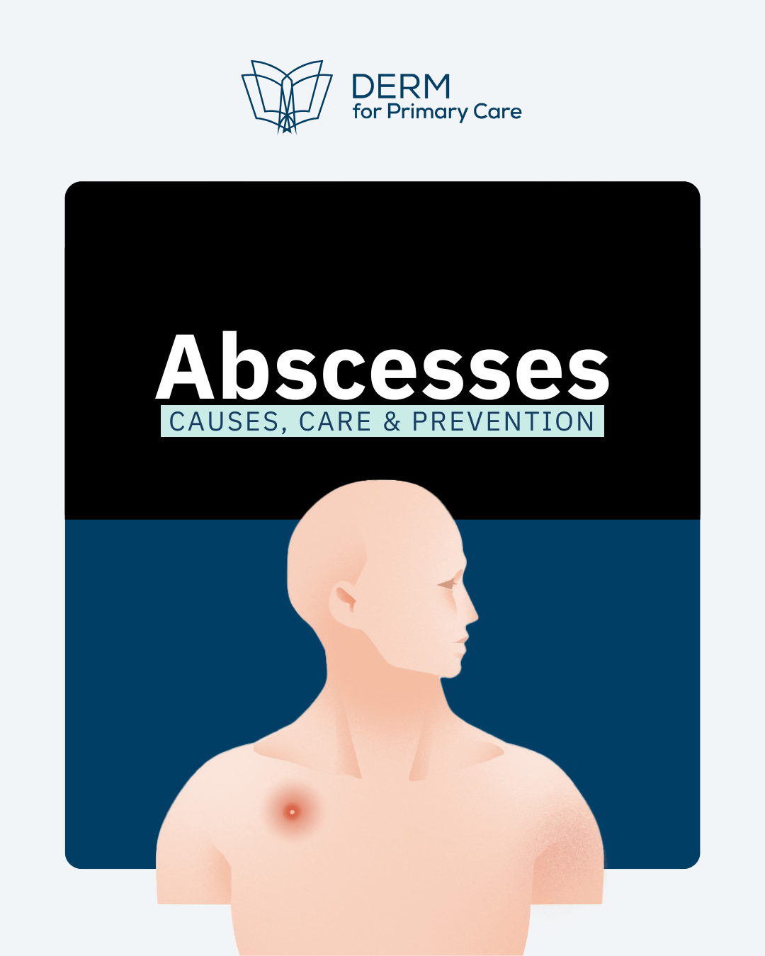 Skin Abscesses FREE Guide.pdf
