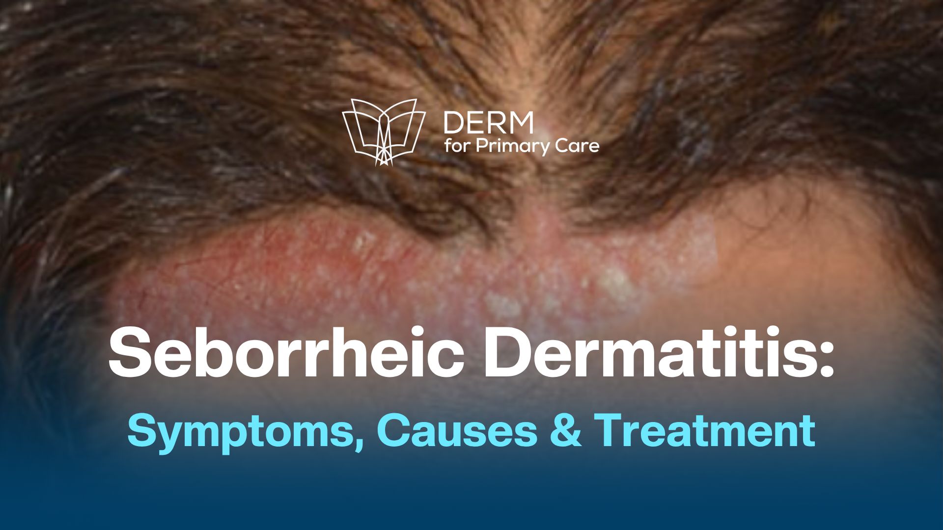 Understanding Seborrheic Dermatitis: Causes, Symptoms, and Treatments