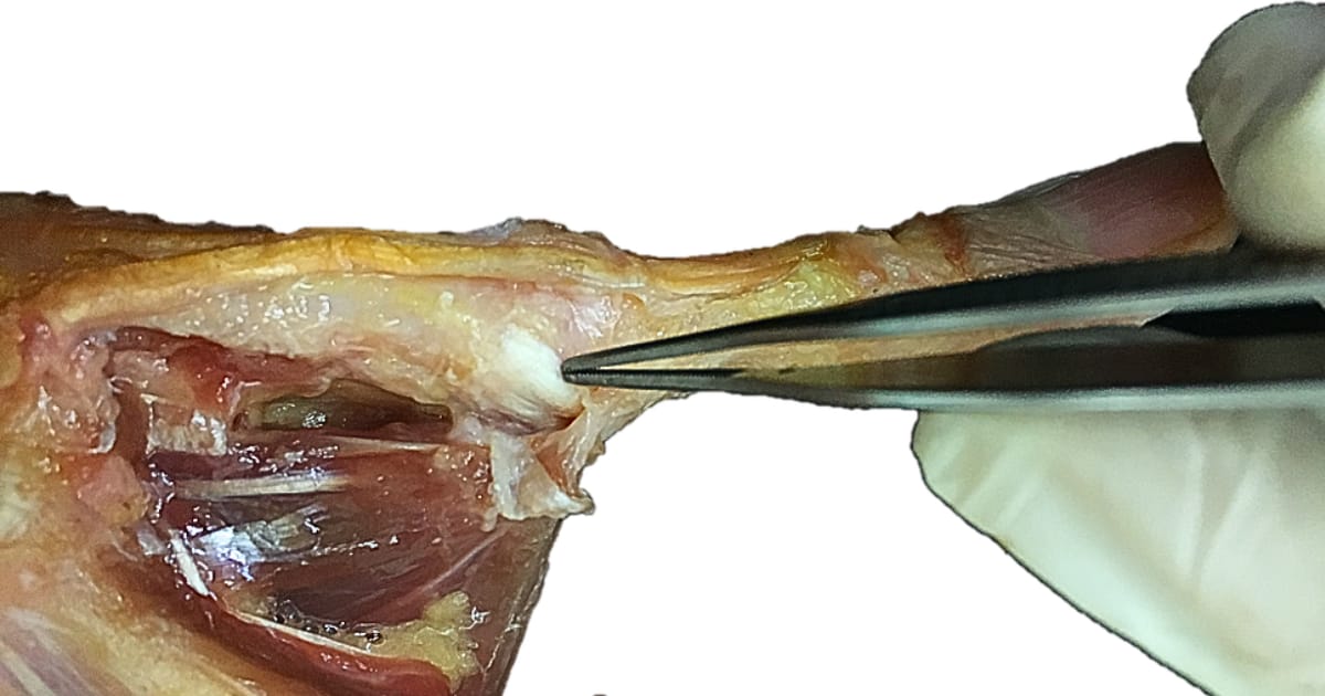 #8. Me duele la interfalángica... pero me han operado el ligamento.