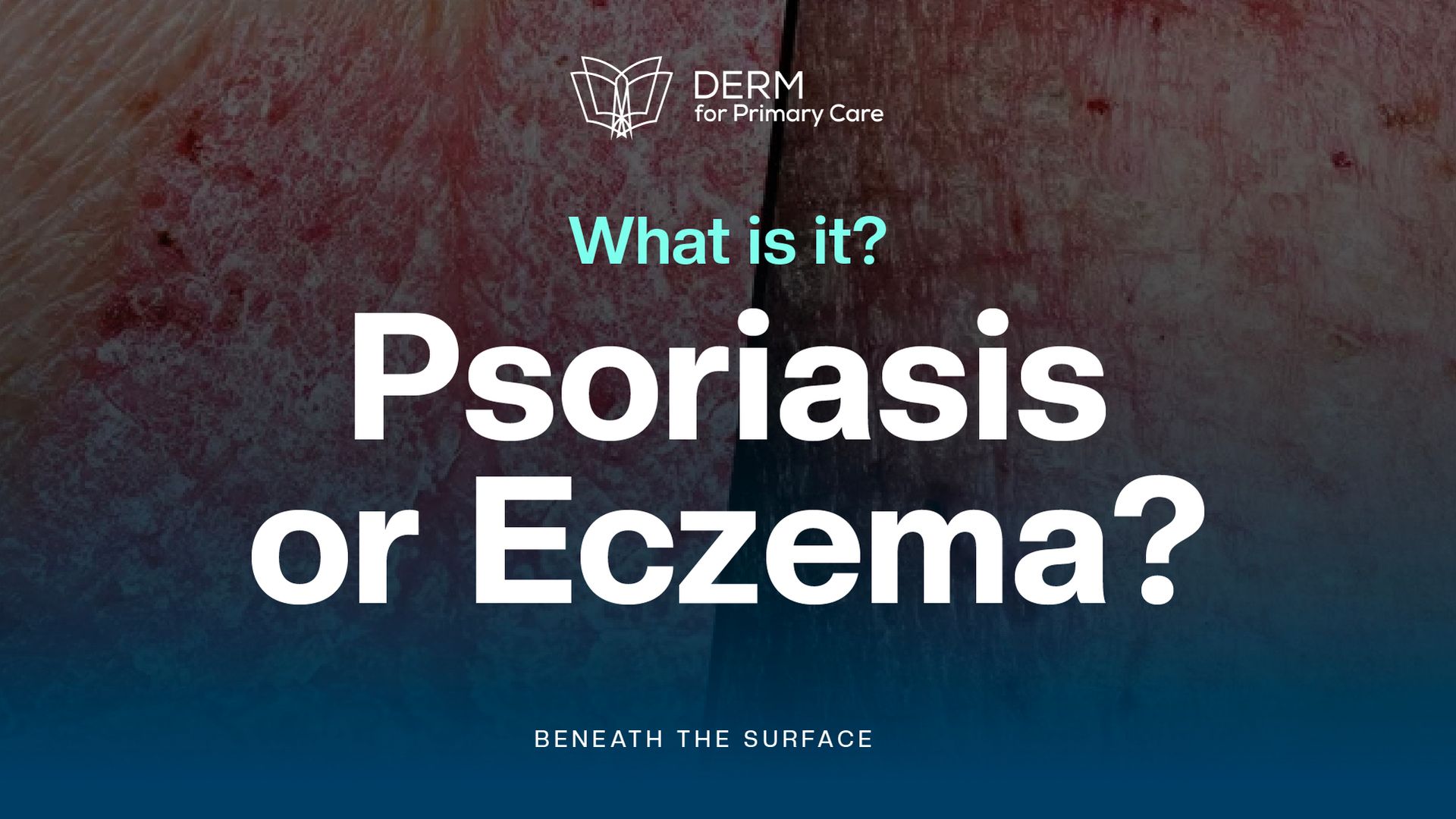 Diagnosis Pitfalls: Psoriasis vs. Eczema