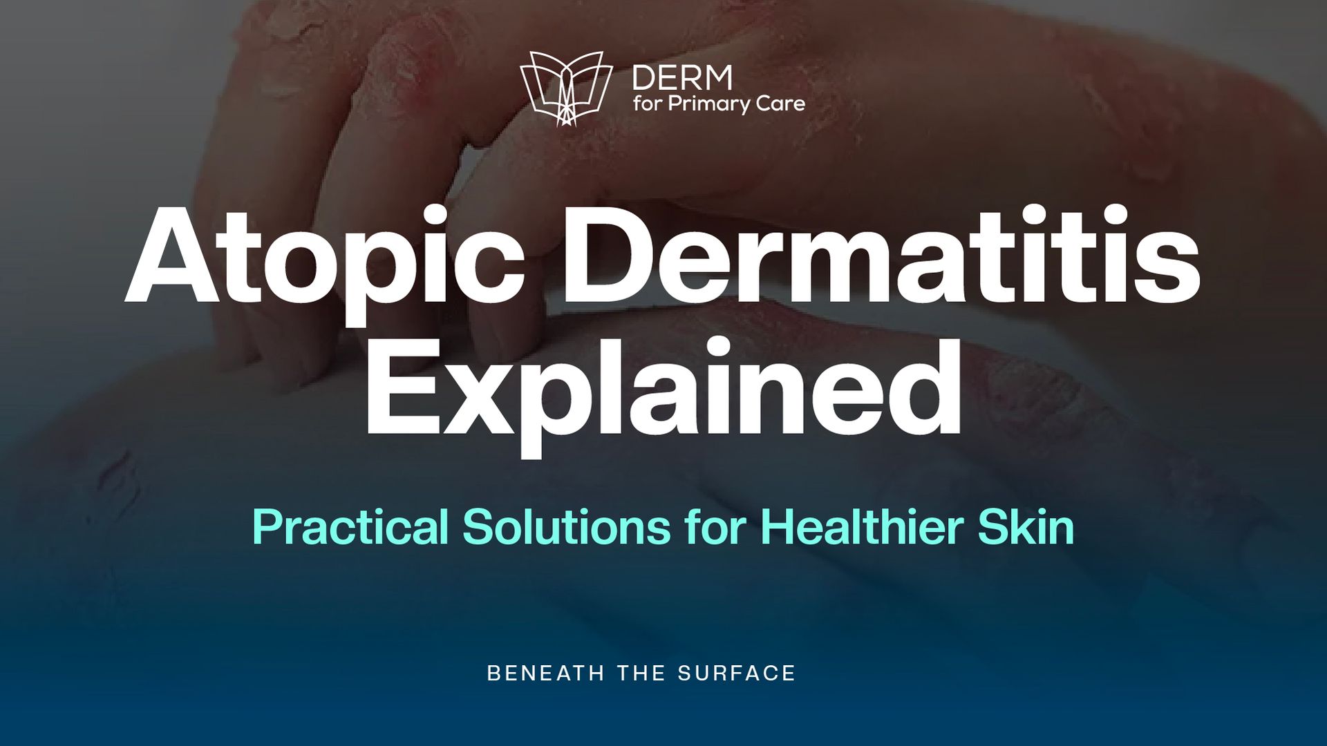 Atopic Dermatitis Uncovered: Effective Solutions & Resources for Better Skin Care
