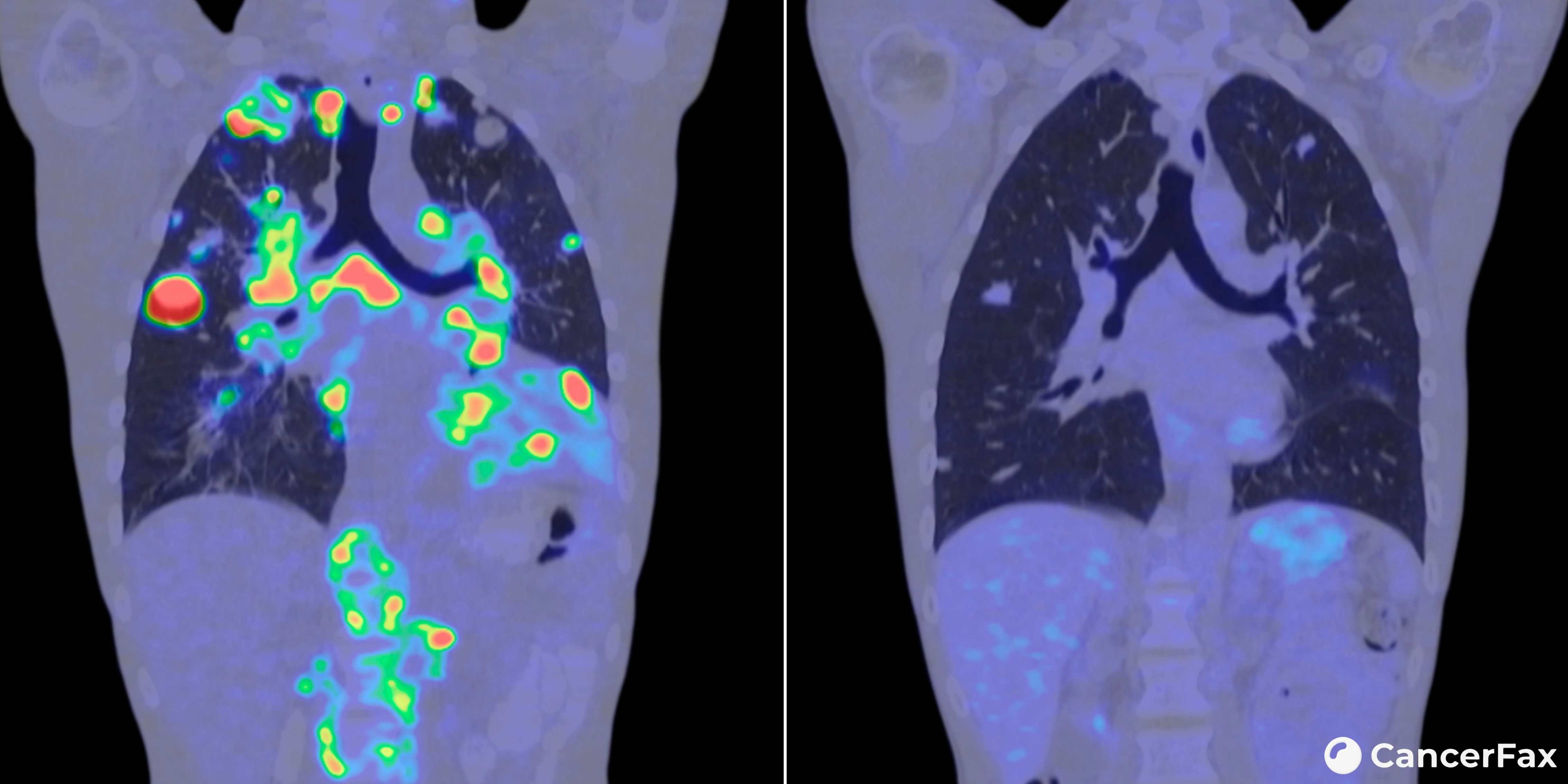 FDA Expands Approval of Hernexeos for First-Line HER2-Mutant Lung Cancer: 76% of Patients Saw Tumors Shrink