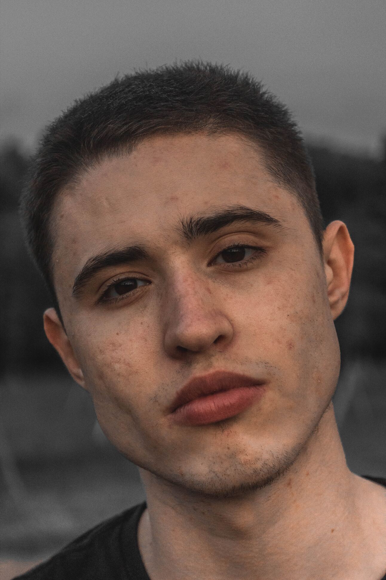 Acne 101: Your Guide to Clearer Skin