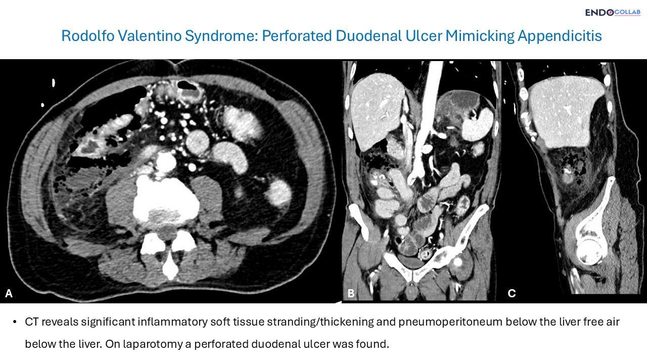 Rodolfo Valentino Syndrome: Perforated Duodenal Ulcer Mimicking Appendicitis