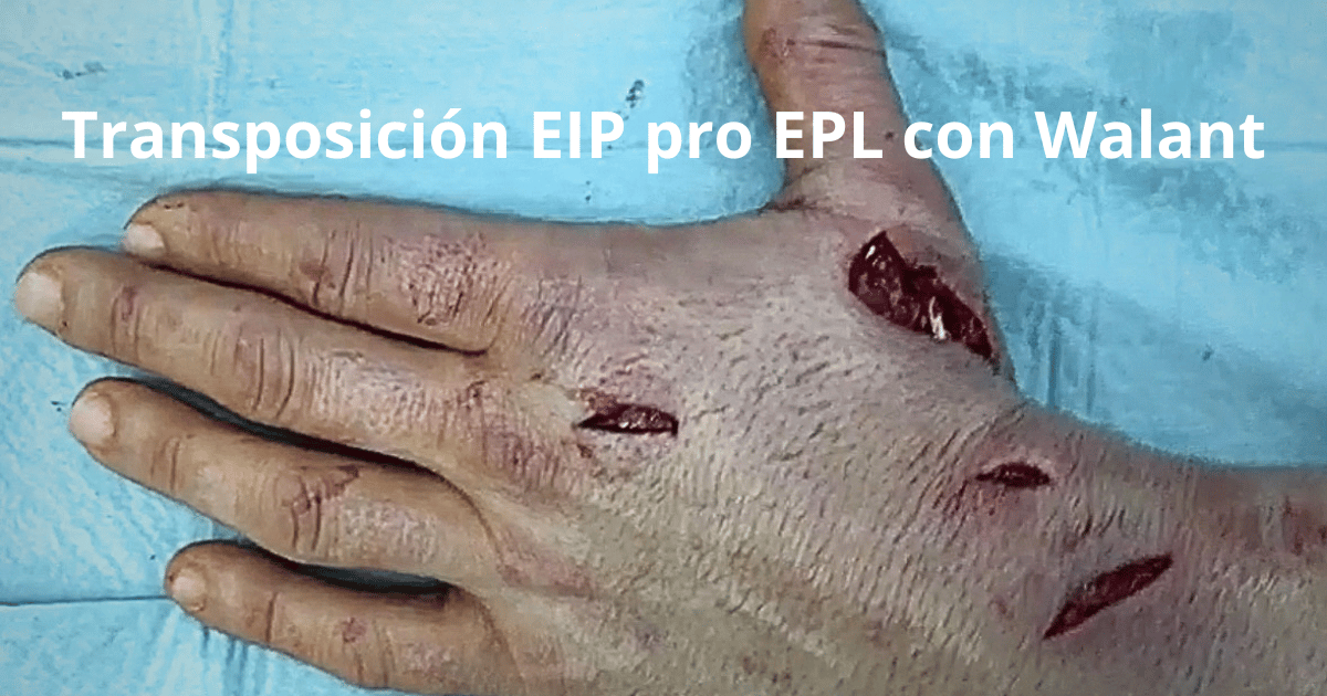 #12. Transposición tendinosa de EIP a EPL
