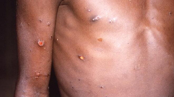 First Probable Case of Monkeypox Found in San Francisco Resident