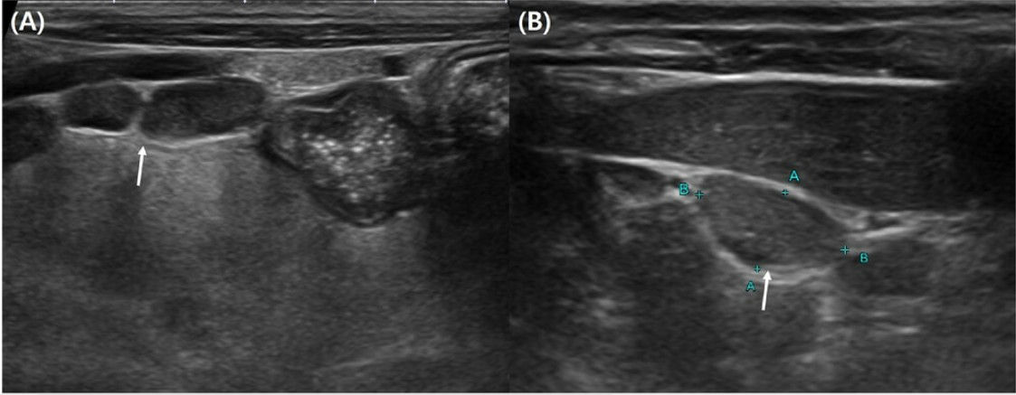 Unusual Fungal Infection Mimics Lymphoma in Persian Cat — Rare Cryptococcosis Case Report