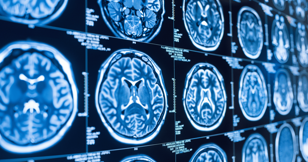 Advanced AI Techniques for Predicting Alzheimer's Disease and Dementia Stages