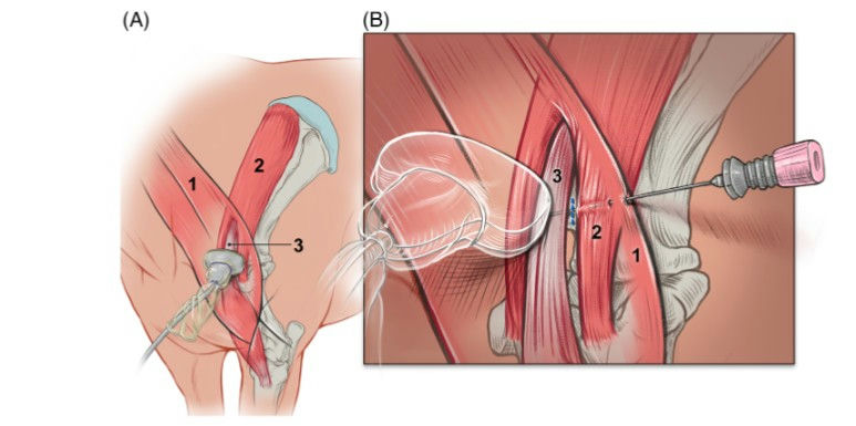 Standing Ultrasound-Guided Tenotomy Restores Function in Chronic Equine Shoulder Injury