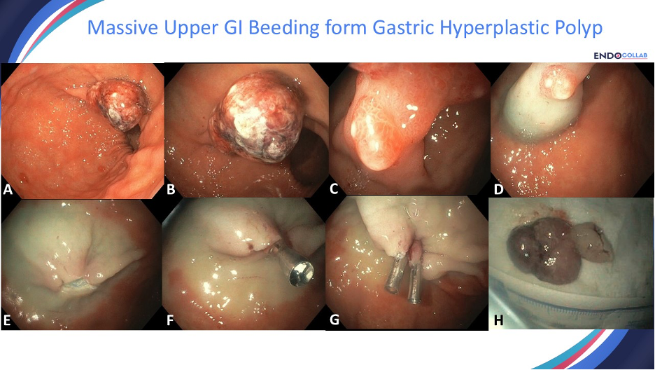 Endoscopic Resection of Giant Gastric Polyp to Treat Upper GI Bleeding