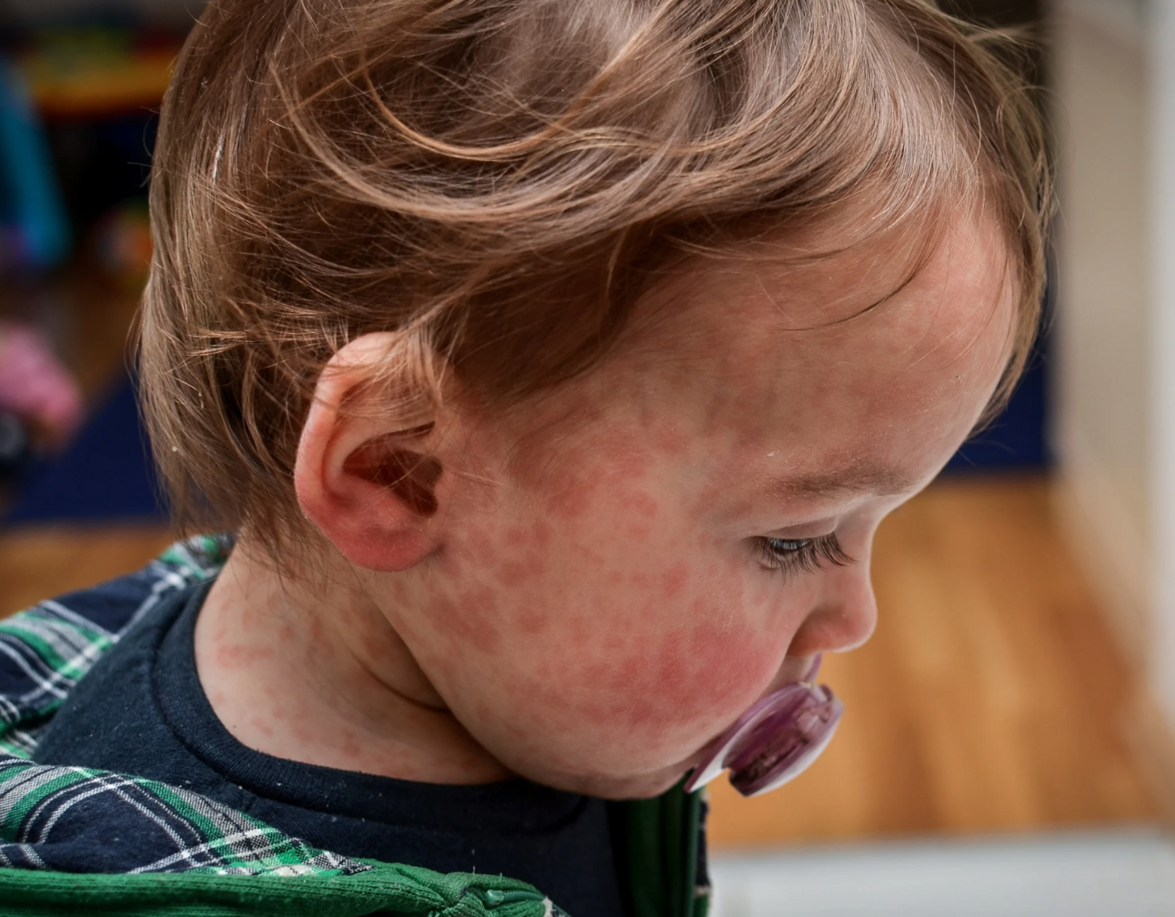 How Worried Should We Be About Measles?