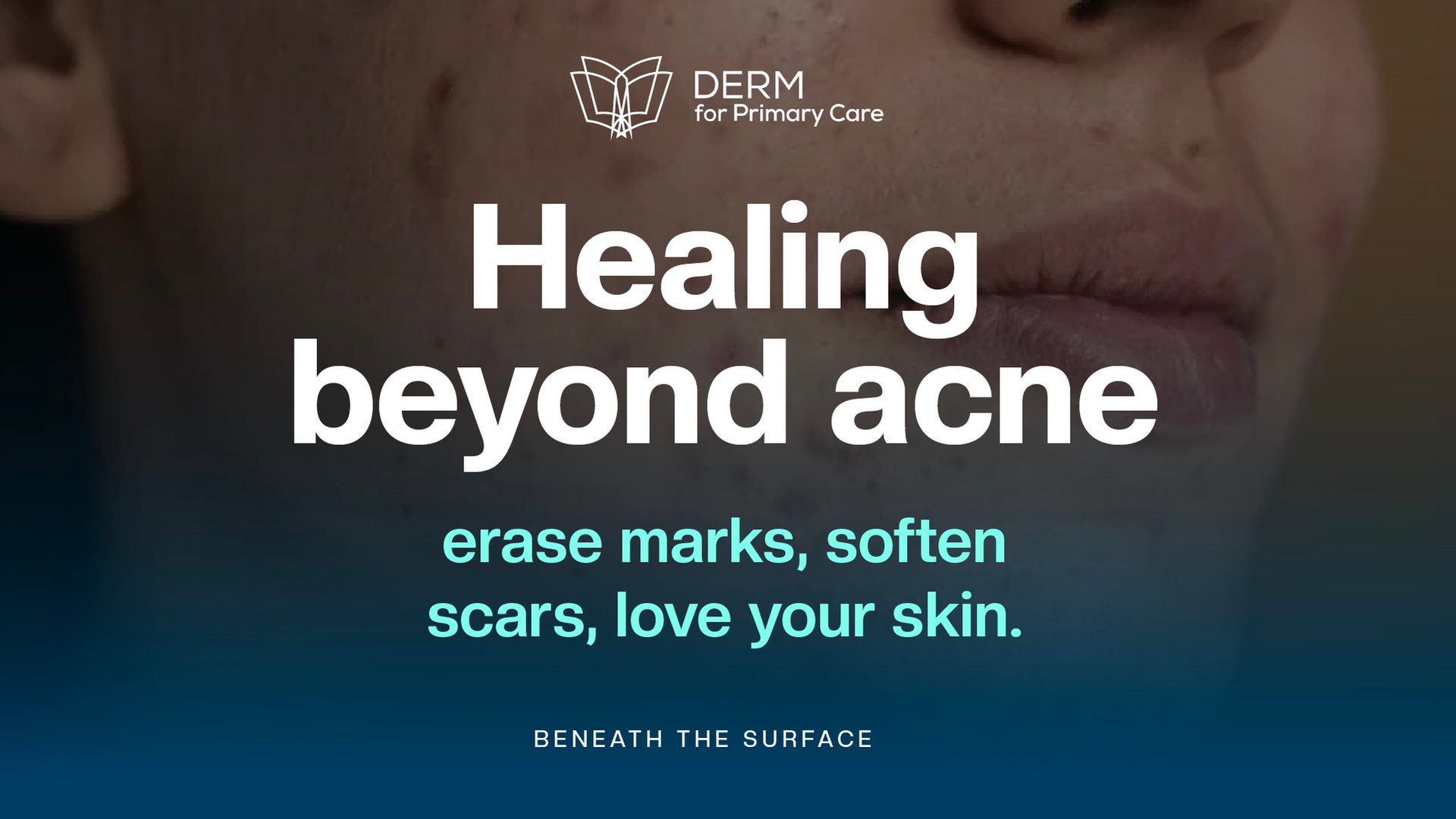 Acne Marks and Scars