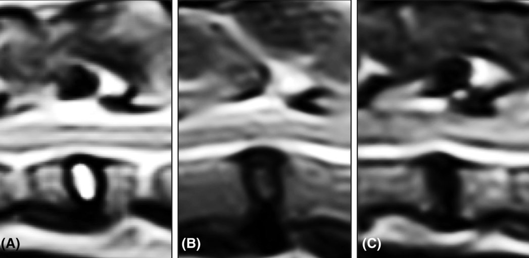 Intervertebral disk degeneration increases your risk of IVDD