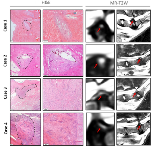 First Veterinary Study Links MRI-Visible “High-Intensity Zones” to Cystic and Granulation Lesions in Dogs