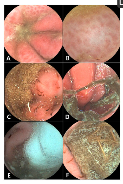 Swallow a Camera: Capsule Endoscopy Quickly Diagnoses Vomiting in Dogs—No Anesthesia Needed