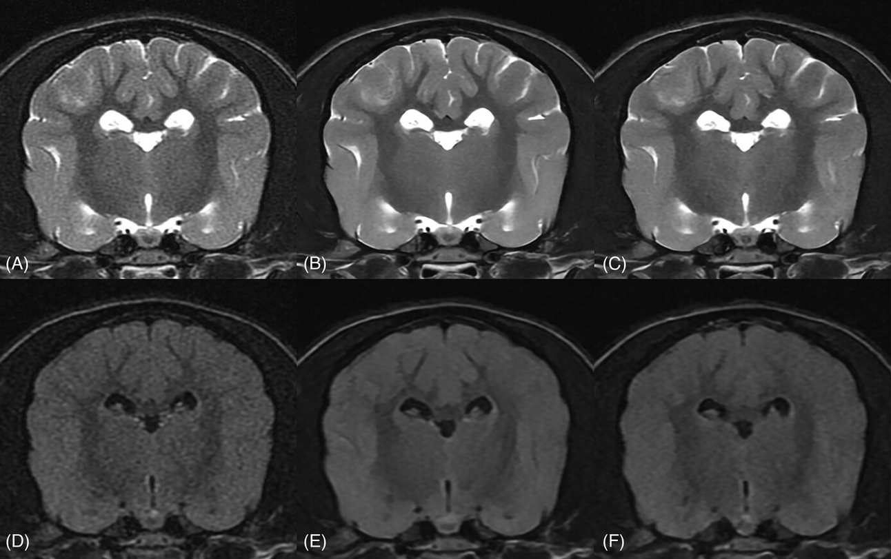 Deep learning imrproves MRI signal