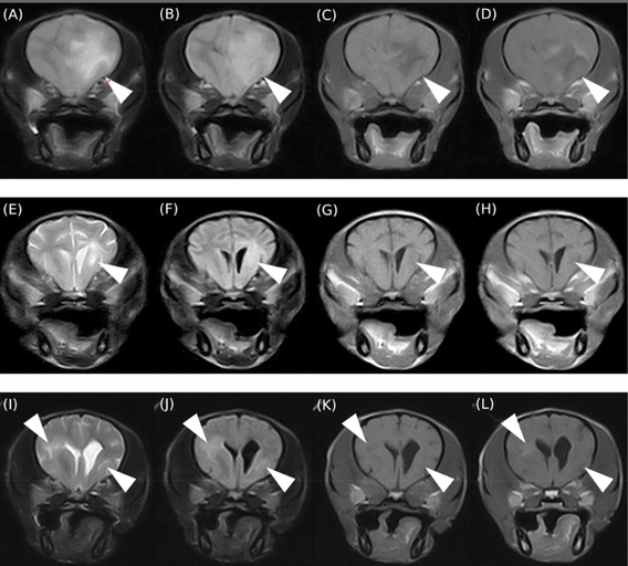 When to Scan Again: MRI Patterns at MUO Relapse Guide Diagnosis and Treatment