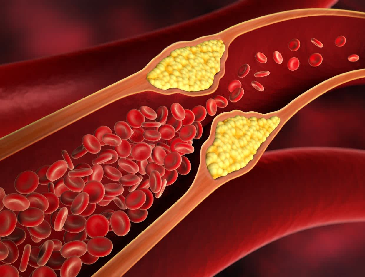 The Cholesterol Myth and Why Heart Disease Isn’t About “Too Much Fat”
