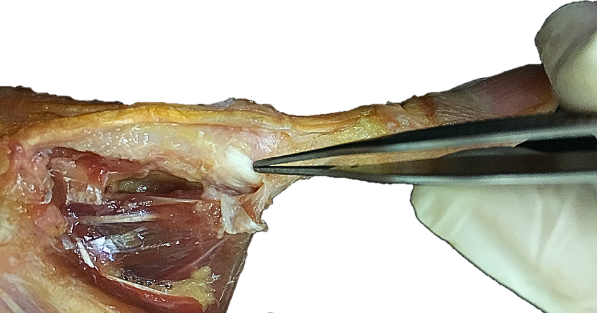 #8. Me duele la interfalángica... pero me han operado el ligamento.