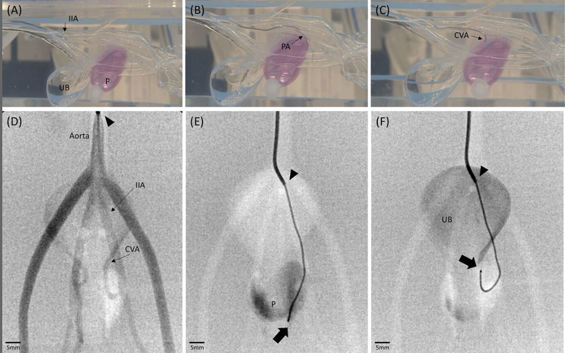 You could get training on prostatic artery embolization