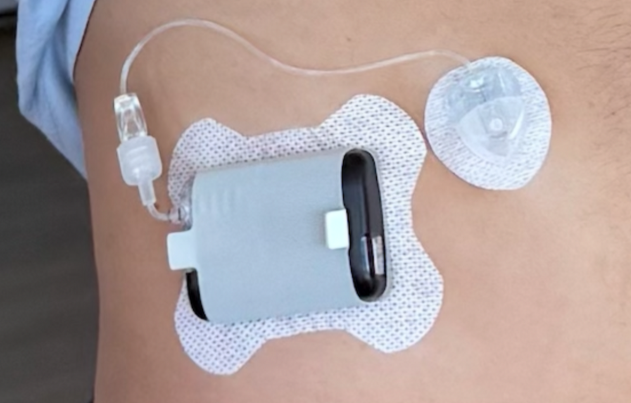 I Thought I Knew My Diabetes—Then I Switched to a Tubed Pump