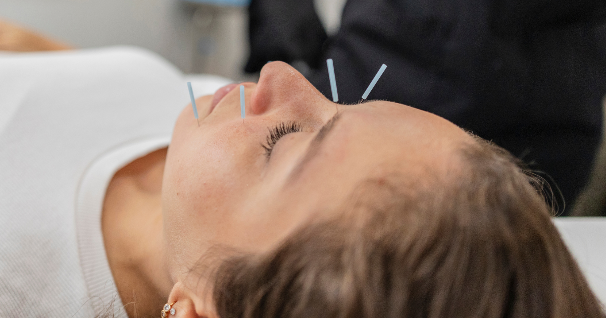 Acupuncture vs. Botox + Facial Elasticity and Melasma