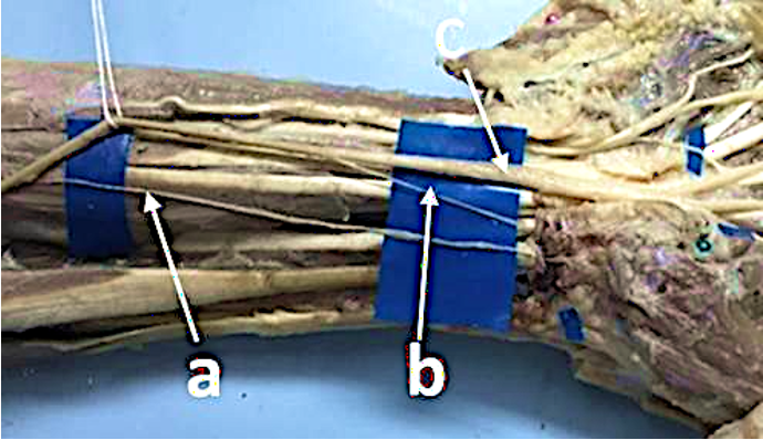 #2. Dolor inexplicable en la mano tras placa volar de radio distal.