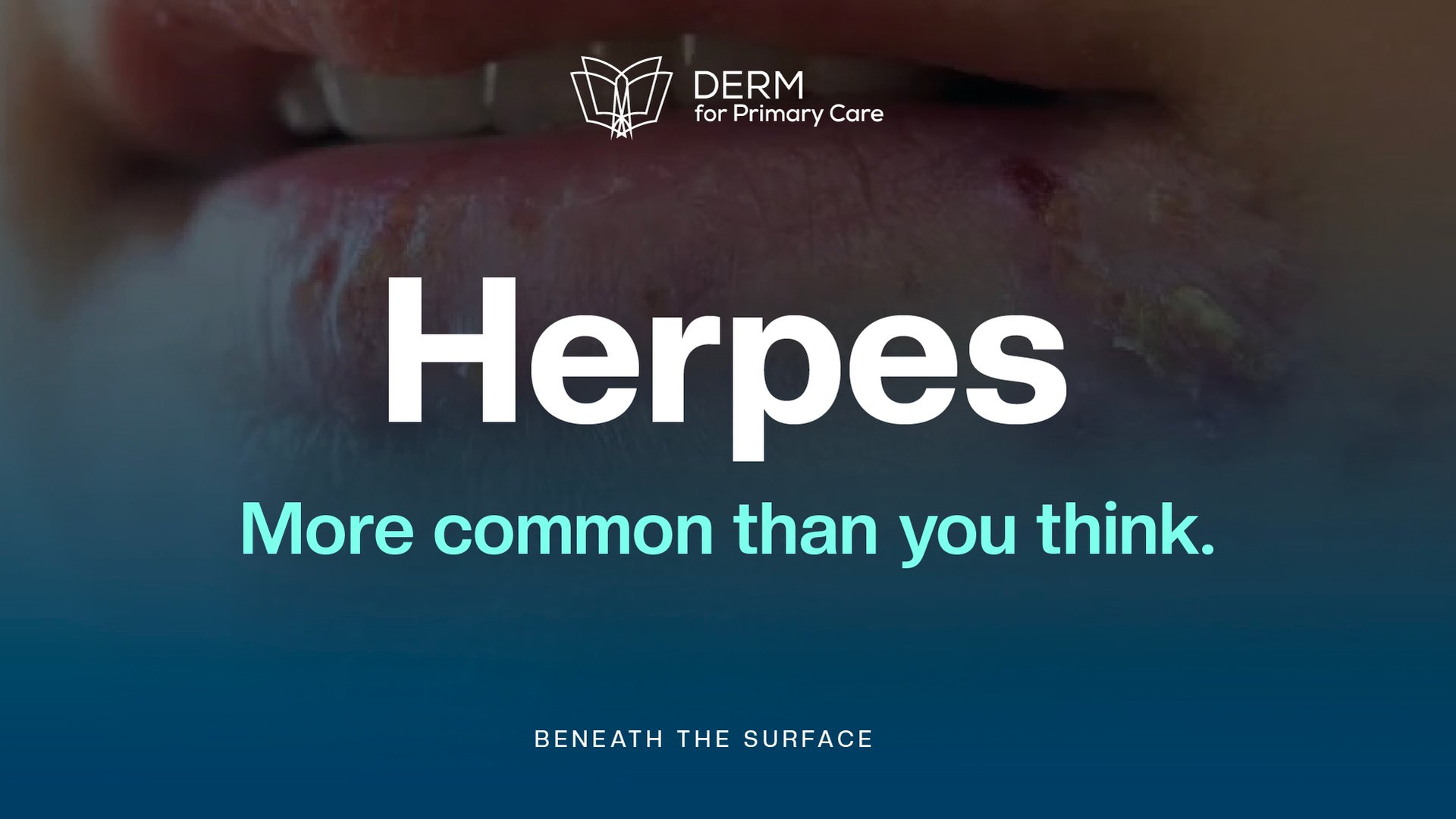 Herpes Demystified: Recognizing the Signs and Dispelling the Myths