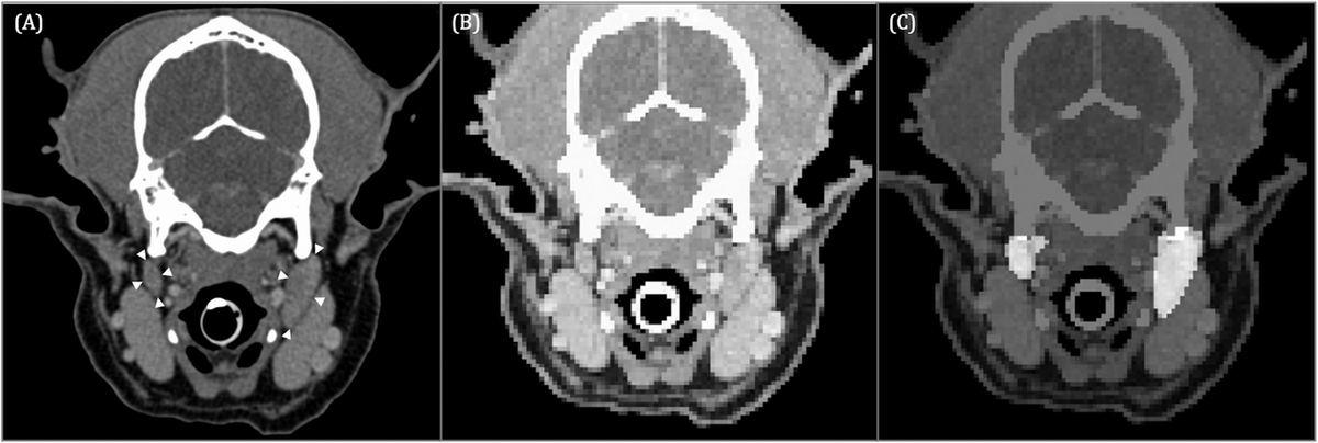 AI can segment medial retropharyngeal LNs