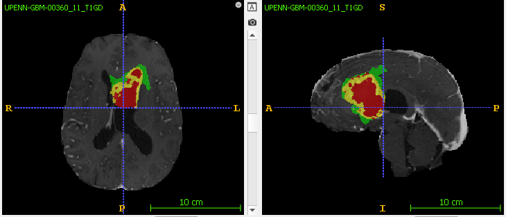 Glioblastoma Brain Tumor Segmentation - Part 1 - Getting the data