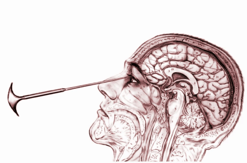 Lobotomia por delivery, peça agora!