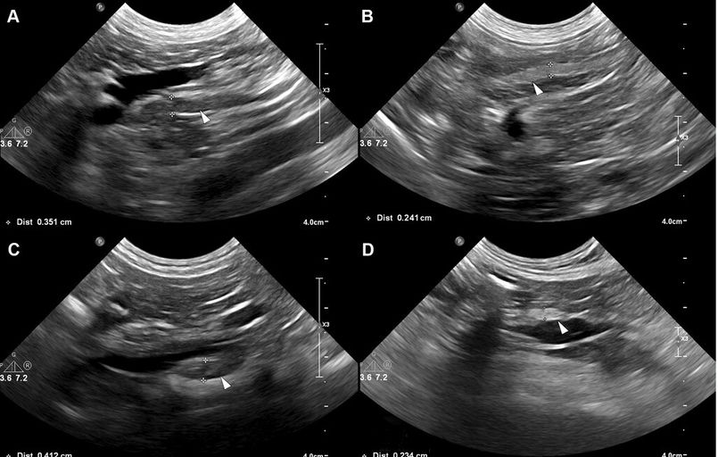 Ultrasound Clue: Thinned, Bright Lymph Nodes Signal Cushing’s in Neutered Dogs