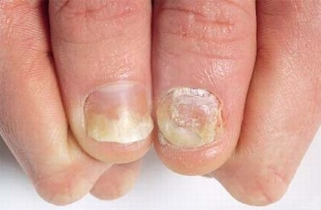 💅 ¿Por qué se caen las uñas durante la quimioterapia y cómo cuidarlas?