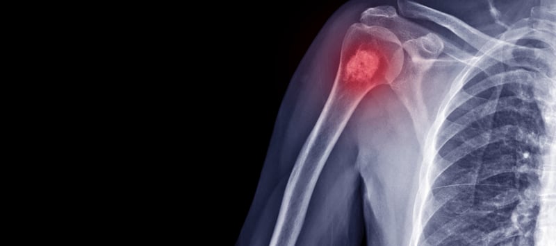 ¿Qué significa tener metástasis ósea? Lo que sí puedes hacer para vivir con calidad