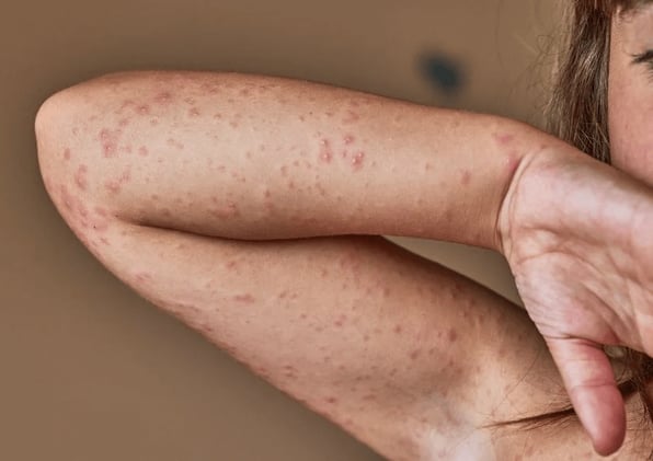Acute Urticaria Explained