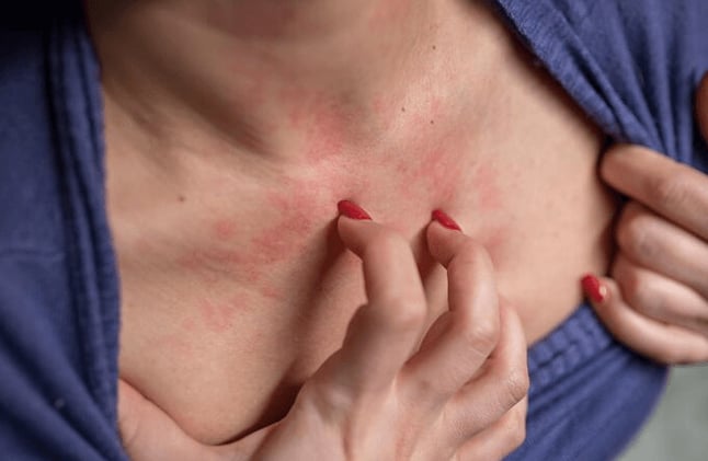 What You Need to Know About Anxiety Rash