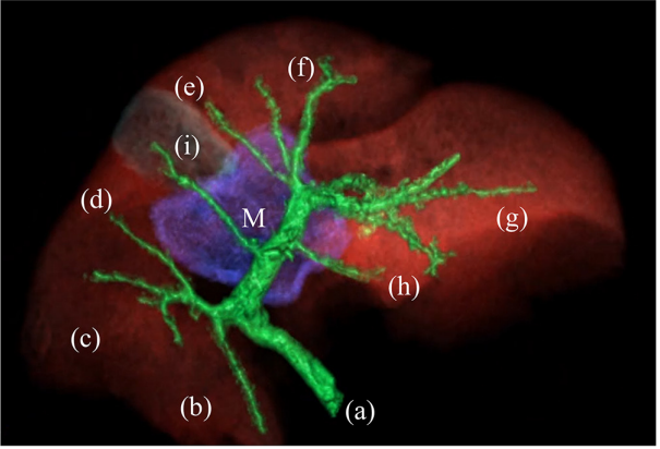 A Liver Out of Place—and Out of Control