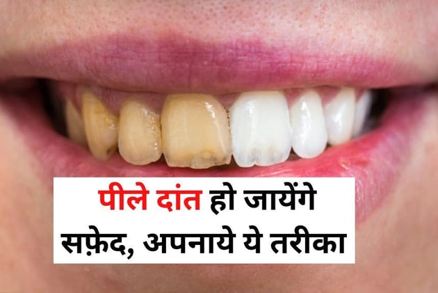 Pile Dant ka Ilaj: क्या आप भी पीले दांतों से हो परेशान, इन उपाय से हो जाएंगे सफेद