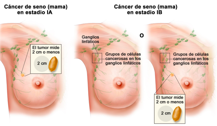 ¿Qué significa que mi cáncer sea “localmente avanzado”?