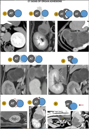 CT Decision Trees Boost Prediction of Adrenal Tumor Adhesions in Dogs and Cats